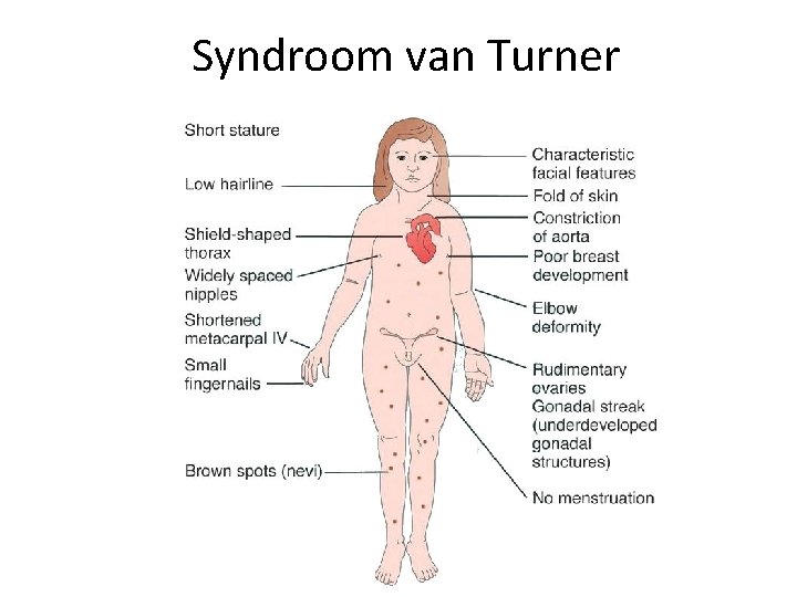 Syndroom van Turner 