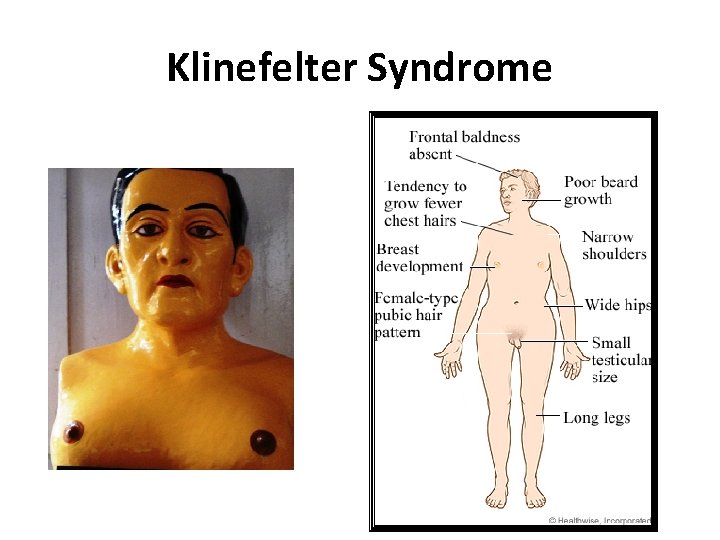 Klinefelter Syndrome 