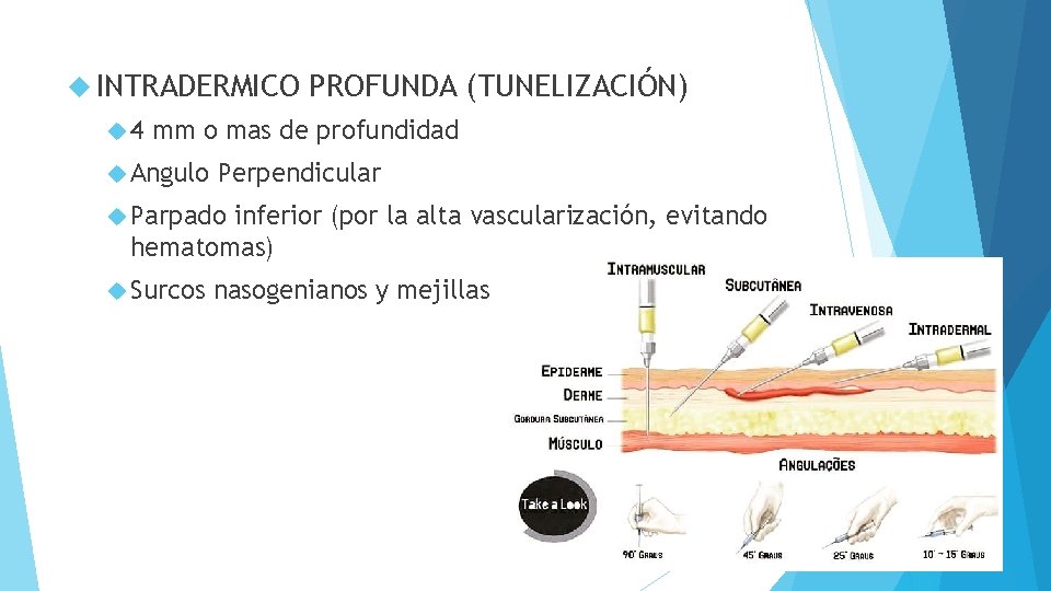  INTRADERMICO 4 PROFUNDA (TUNELIZACIÓN) mm o mas de profundidad Angulo Perpendicular Parpado inferior