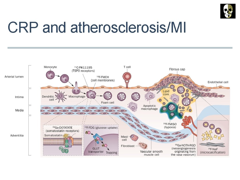 CRP and atherosclerosis/MI 