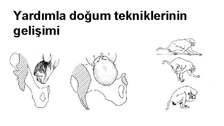 Yardımla doğum tekniklerinin gelişimi Yardımla doğum tekniklerinin gelişimi