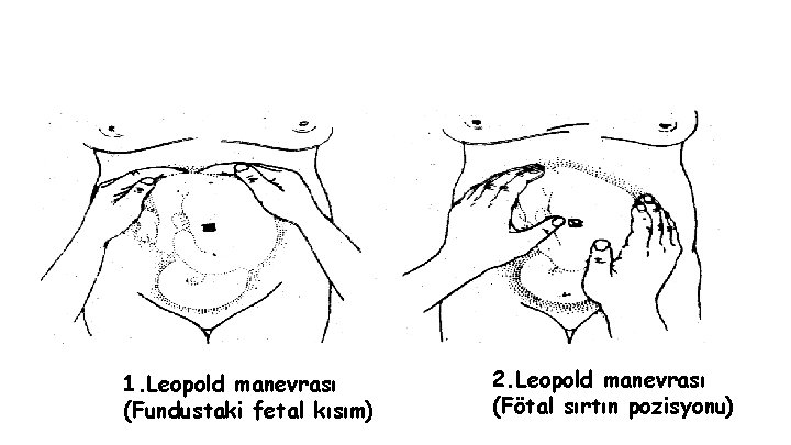 Leopold Manevraları 1. Leopold manevrası (Fundustaki fetal kısım) 2. Leopold manevrası (Fötal sırtın pozisyonu) Leopold Manevraları 1. Leopold manevrası (Fundustaki fetal kısım) 2. Leopold manevrası (Fötal sırtın pozisyonu)