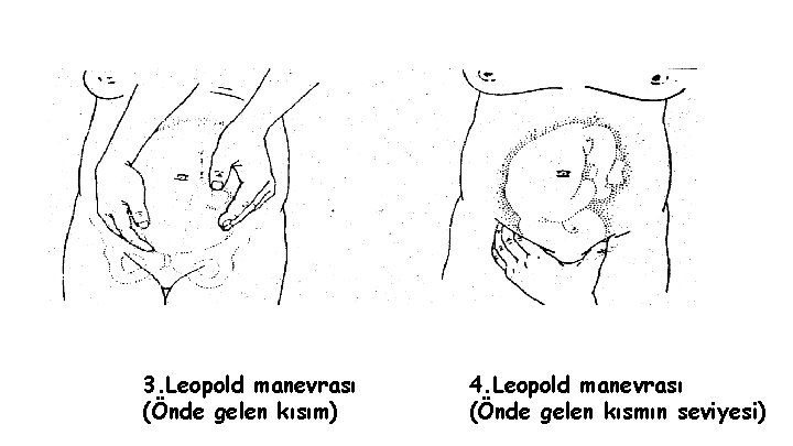 3. Leopold manevrası (Önde gelen kısım) 4. Leopold manevrası (Önde gelen kısmın seviyesi) 3. Leopold manevrası (Önde gelen kısım) 4. Leopold manevrası (Önde gelen kısmın seviyesi)