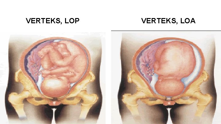 VERTEKS, LOP VERTEKS, LOA VERTEKS, LOP VERTEKS, LOA