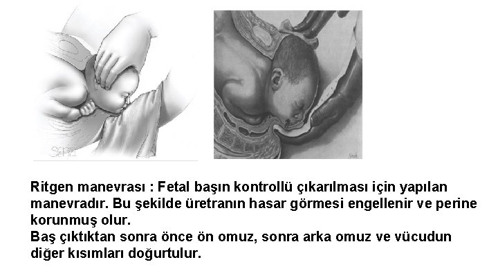 Ritgen manevrası : Fetal başın kontrollü çıkarılması için yapılan manevradır. Bu şekilde üretranın hasar Ritgen manevrası : Fetal başın kontrollü çıkarılması için yapılan manevradır. Bu şekilde üretranın hasar