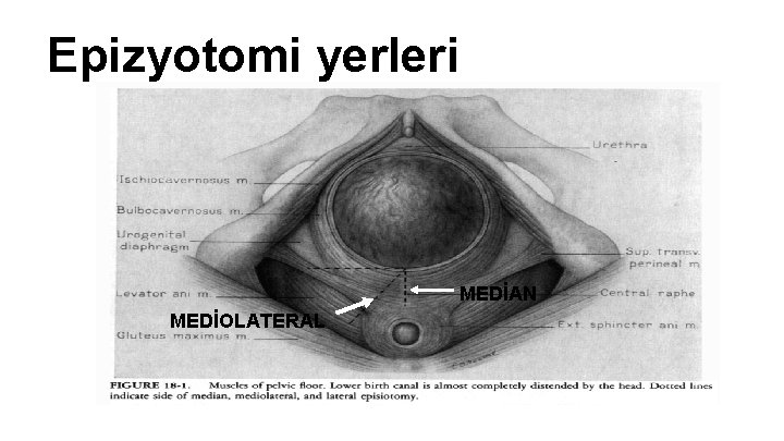 Epizyotomi yerleri MEDİAN MEDİOLATERAL Epizyotomi yerleri MEDİAN MEDİOLATERAL