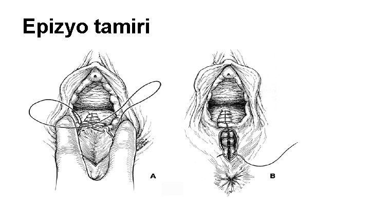 Epizyo tamiri Epizyo tamiri