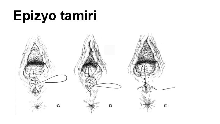 Epizyo tamiri Epizyo tamiri