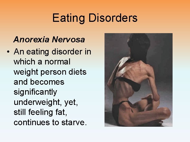 Eating Disorders Anorexia Nervosa • An eating disorder in which a normal weight person