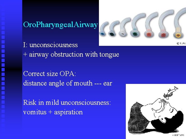 Oro. Pharyngeal. Airway I: unconsciousness + airway obstruction with tongue Correct size OPA: distance