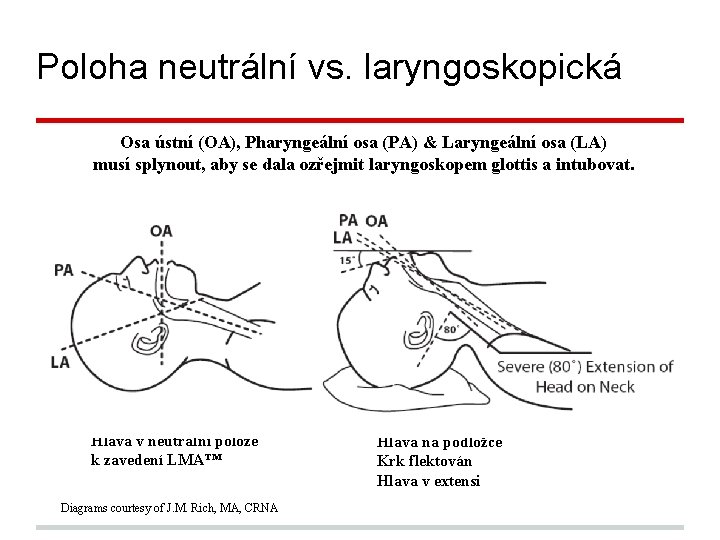 Poloha neutrální vs. laryngoskopická Osa ústní (OA), Pharyngeální osa (PA) & Laryngeální osa (LA)