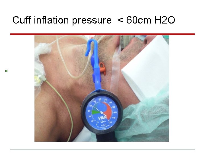 Cuff inflation pressure < 60 cm H 2 O 
