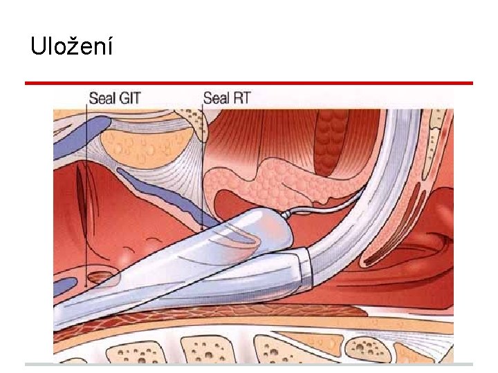 Uložení Korektní uložení-ventrální část masky proti glotis, Vrchol DT leží za krikoidní chrupavkou proti