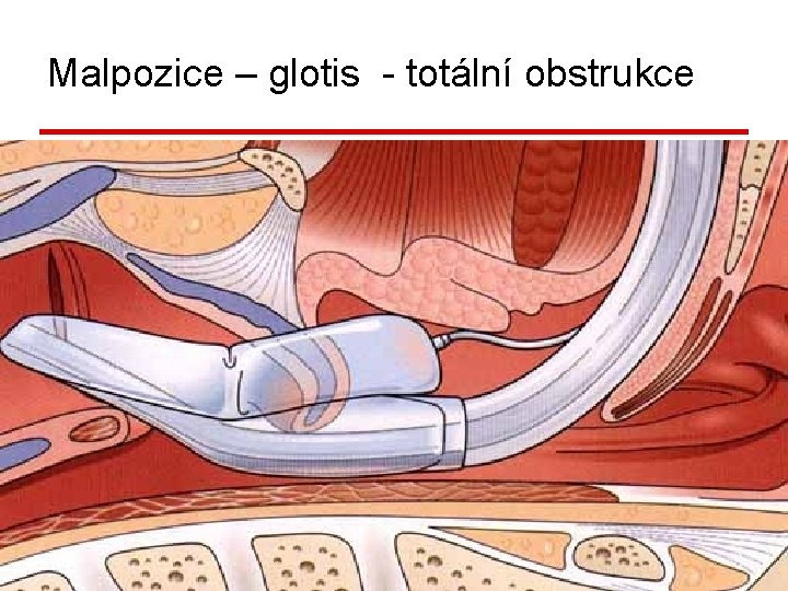 Malpozice – glotis - totální obstrukce Pro. Seal LMA vrchol v glotis-obstrukce DC a