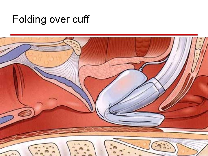 Folding over cuff Nebezpečně zvyšuje riziko aspirace lze předejít zavedením nasogastrické sondy, která ozřejmí