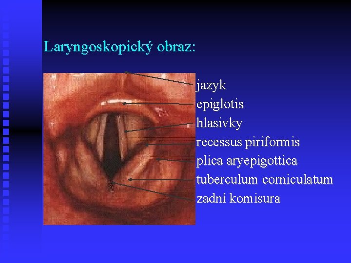Laryngoskopický obraz: jazyk epiglotis hlasivky recessus piriformis plica aryepigottica tuberculum corniculatum zadní komisura 