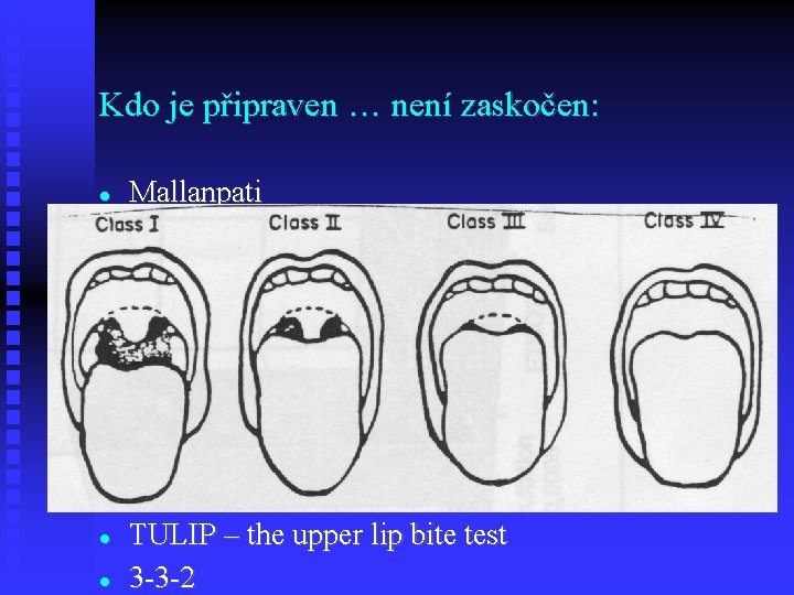 Kdo je připraven … není zaskočen: Mallanpati TULIP – the upper lip bite test