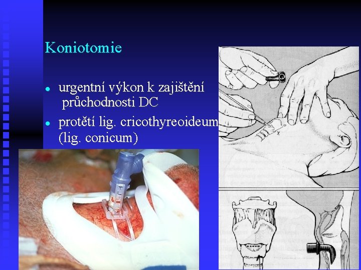 Koniotomie urgentní výkon k zajištění průchodnosti DC protětí lig. cricothyreoideum (lig. conicum) 