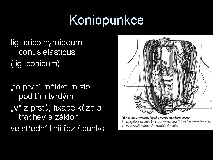 Koniopunkce lig. cricothyroideum, conus elasticus (lig. conicum) „to první měkké místo pod tím tvrdým“