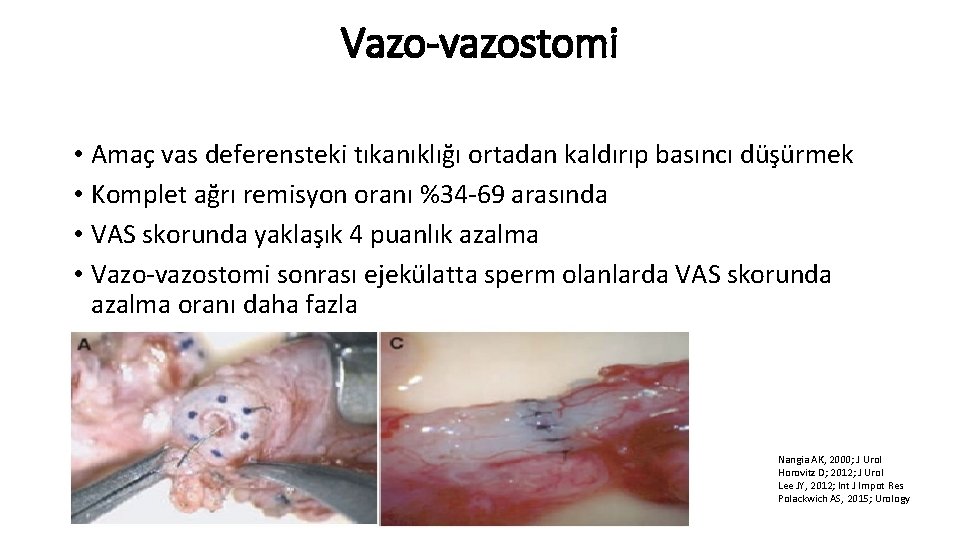Vazo-vazostomi • Amaç vas deferensteki tıkanıklığı ortadan kaldırıp basıncı düşürmek • Komplet ağrı remisyon