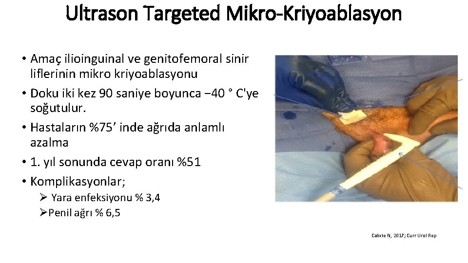 Ultrason Targeted Mikro-Kriyoablasyon • Amaç ilioinguinal ve genitofemoral sinir liflerinin mikro kriyoablasyonu • Doku