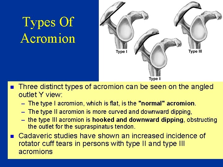 Types Of Acromion n Three distinct types of acromion can be seen on the