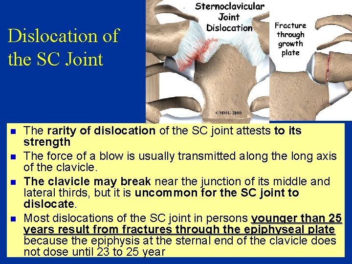 Dislocation of the SC Joint n n The rarity of dislocation of the SC
