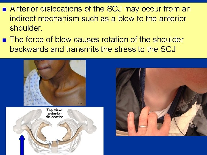 n n Anterior dislocations of the SCJ may occur from an indirect mechanism such