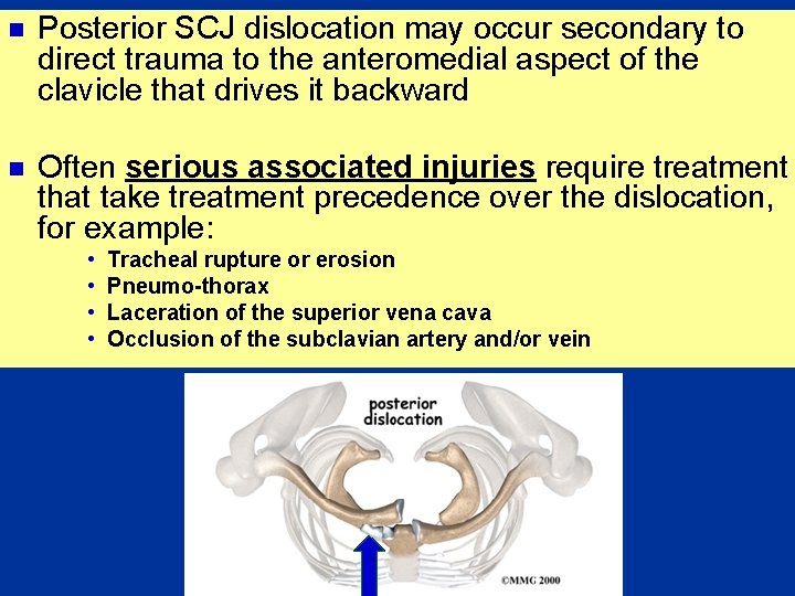 n Posterior SCJ dislocation may occur secondary to direct trauma to the anteromedial aspect