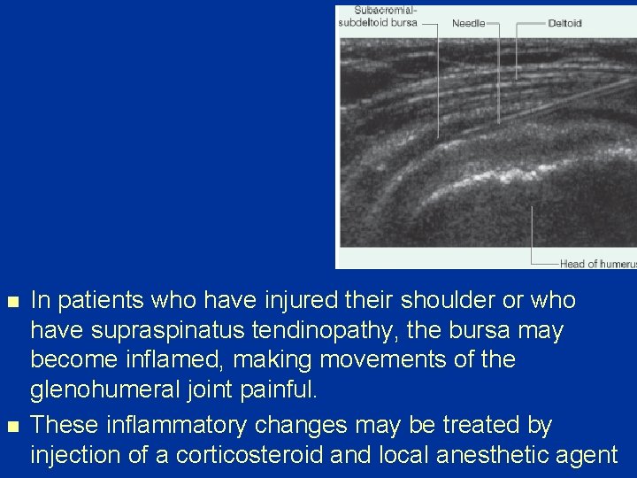 n n In patients who have injured their shoulder or who have supraspinatus tendinopathy,
