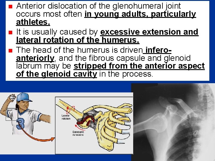 n n n Anterior dislocation of the glenohumeral joint occurs most often in young