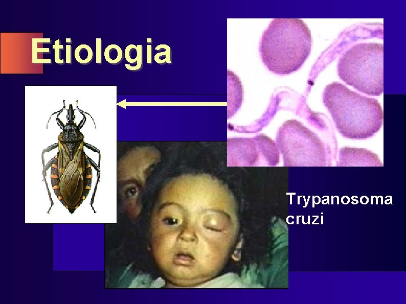 Etiologia Trypanosoma cruzi 