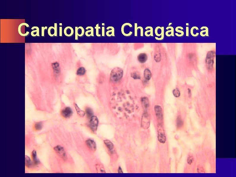 Cardiopatia Chagásica 