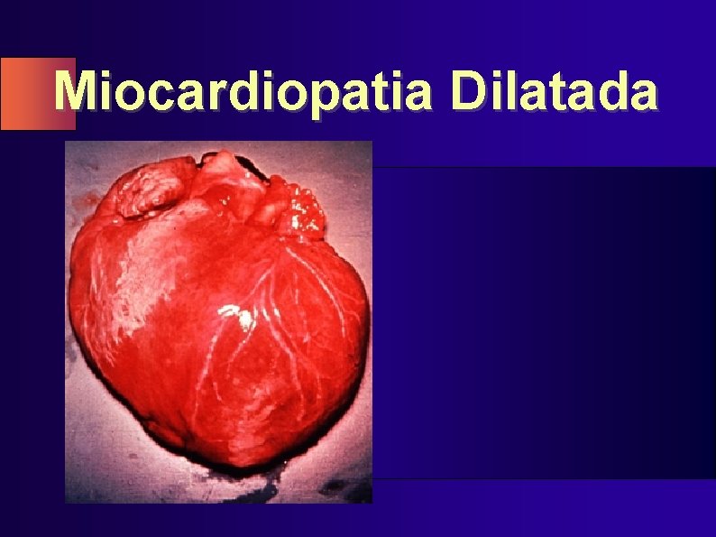 Miocardiopatia Dilatada 