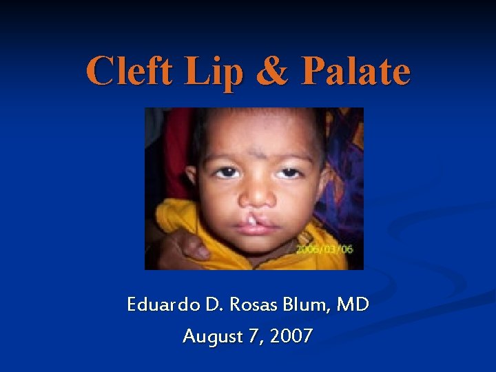 Cleft Lip & Palate Eduardo D. Rosas Blum, MD August 7, 2007 