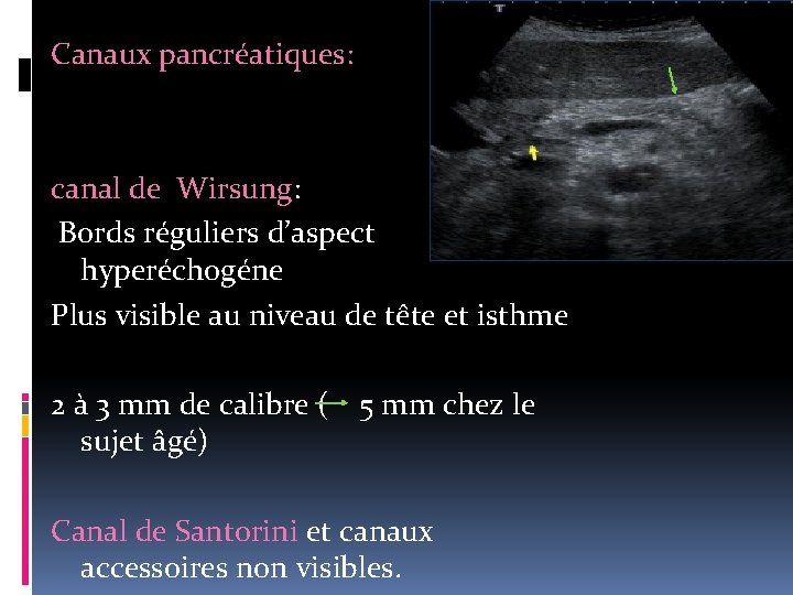 Canaux pancréatiques: canal de Wirsung: Bords réguliers d’aspect hyperéchogéne Plus visible au niveau de