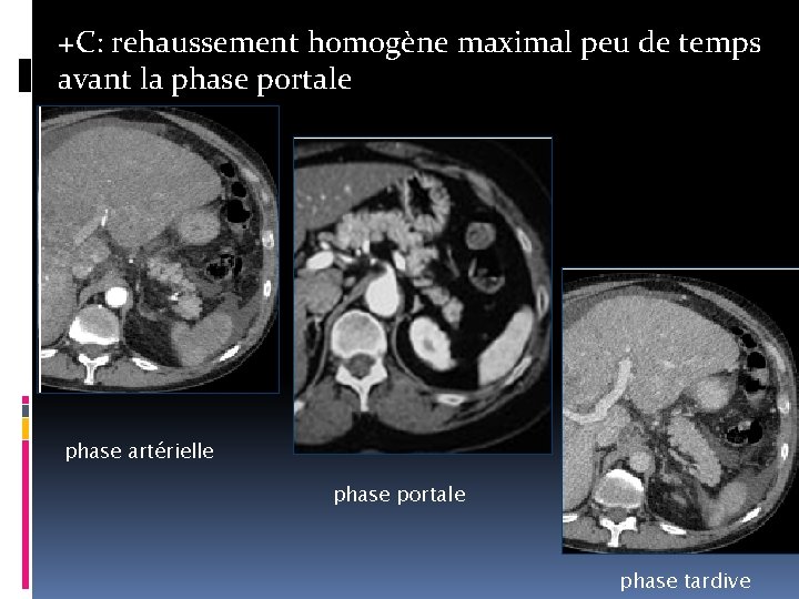 +C: rehaussement homogène maximal peu de temps avant la phase portale phase artérielle phase