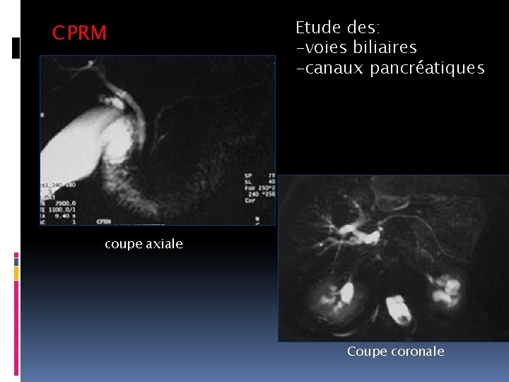 CPRM Etude des: -voies biliaires -canaux pancréatiques coupe axiale Coupe coronale 
