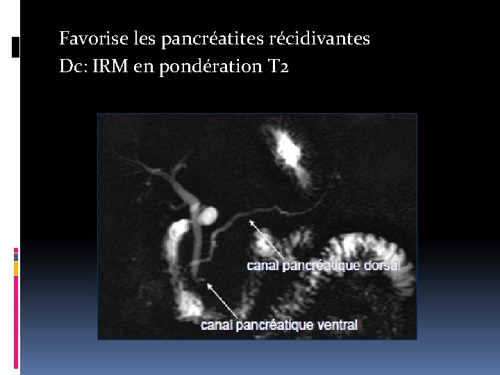 Favorise les pancréatites récidivantes Dc: IRM en pondération T 2 