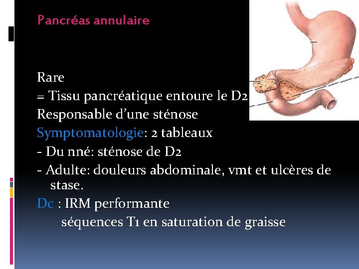 Pancréas annulaire Rare = Tissu pancréatique entoure le D 2. Responsable d’une sténose Symptomatologie: