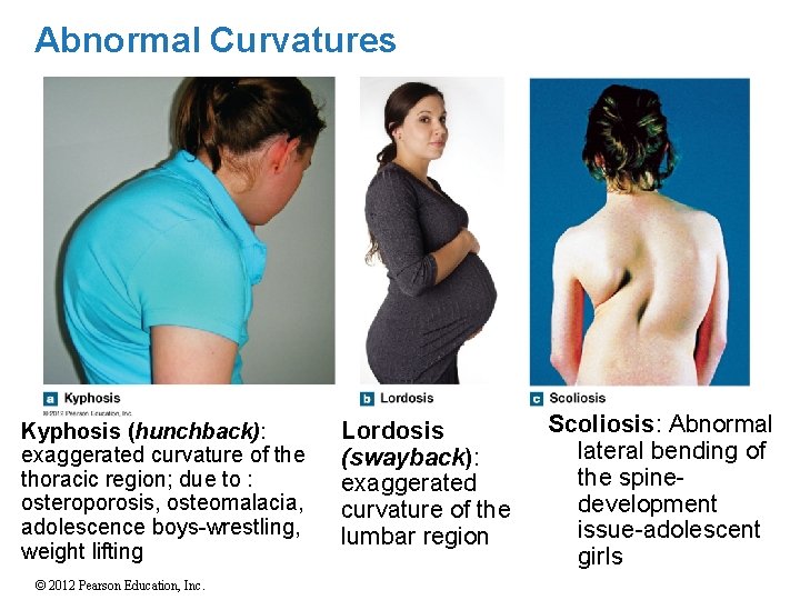 Abnormal Curvatures Kyphosis (hunchback): exaggerated curvature of the thoracic region; due to : osteroporosis,