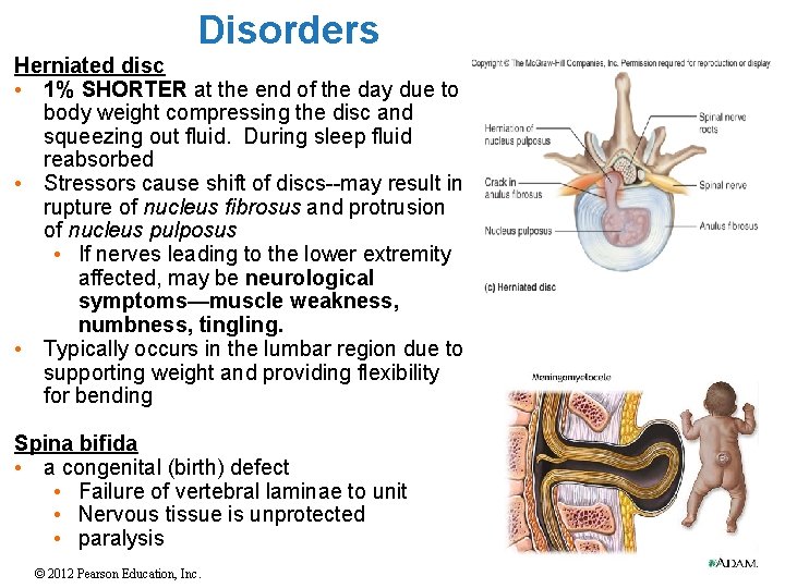 Disorders Herniated disc • 1% SHORTER at the end of the day due to