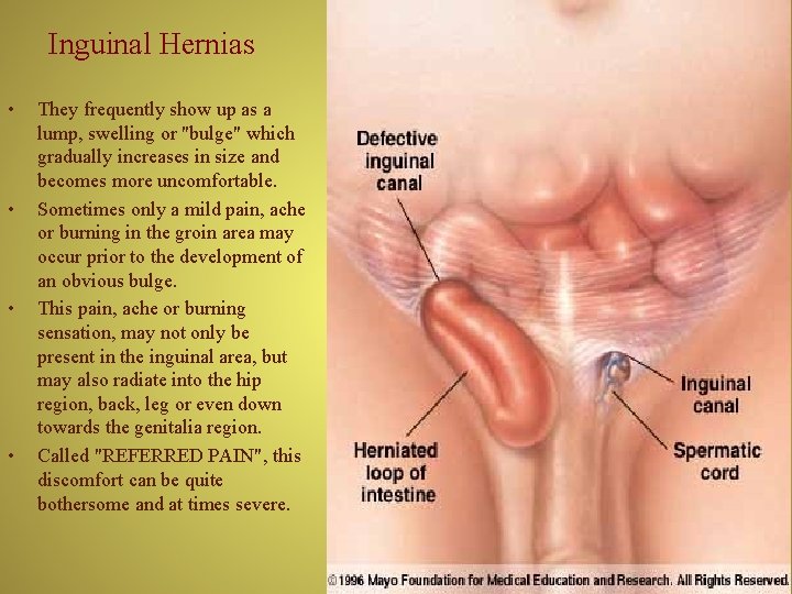 Inguinal Hernias • • They frequently show up as a lump, swelling or "bulge"