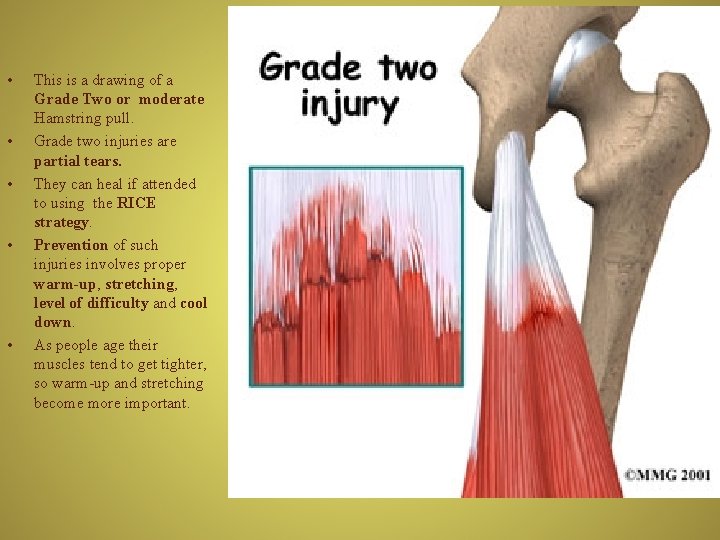  • • • This is a drawing of a Grade Two or moderate