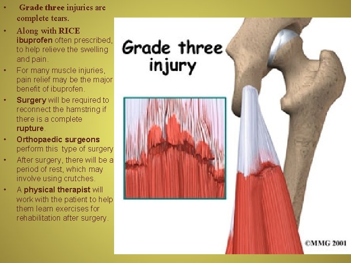  • • Grade three injuries are complete tears. Along with RICE ibuprofen often