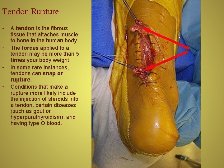Tendon Rupture • • A tendon is the fibrous tissue that attaches muscle to