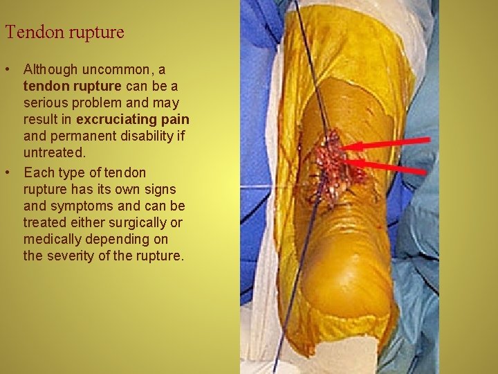 Tendon rupture • Although uncommon, a tendon rupture can be a serious problem and