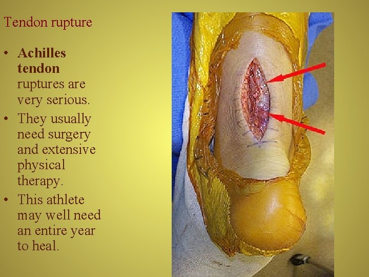 Tendon rupture • Achilles tendon ruptures are very serious. • They usually need surgery