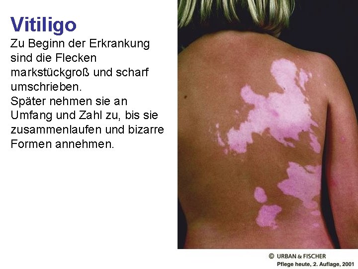 Vitiligo Zu Beginn der Erkrankung sind die Flecken markstückgroß und scharf umschrieben. Später nehmen Vitiligo Zu Beginn der Erkrankung sind die Flecken markstückgroß und scharf umschrieben. Später nehmen