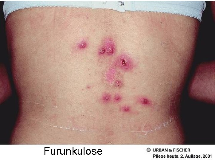 Furunkulose Furunkulose
